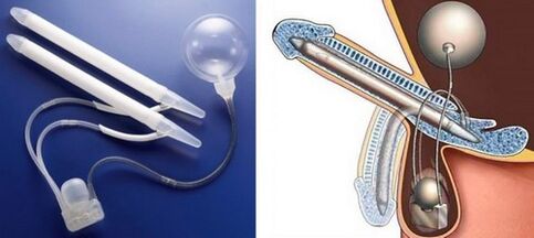 penile enlargement surgery