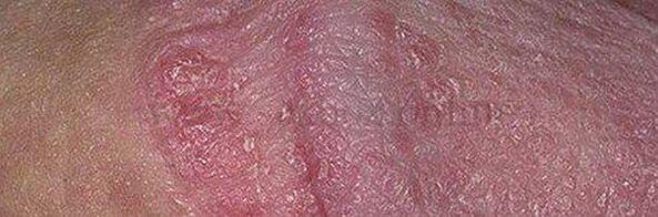 Dry skin and ulcers on the head of the penis after using baking soda